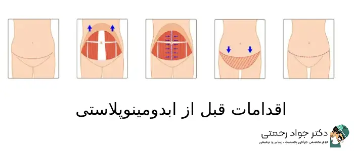 اقدامات قبل از ابدومینوپلاستی