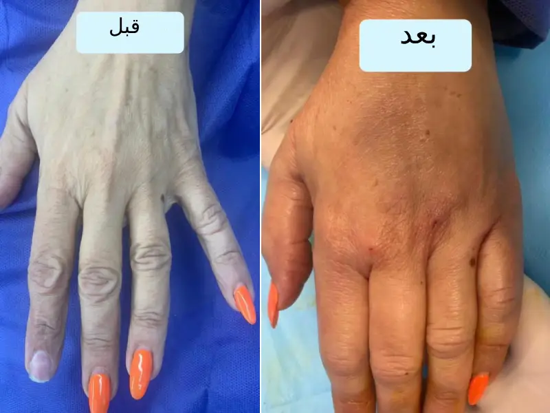 عکس چربی به دست