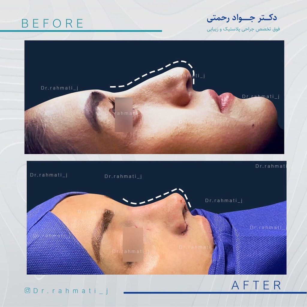 قبل و بعد جراحی بینی