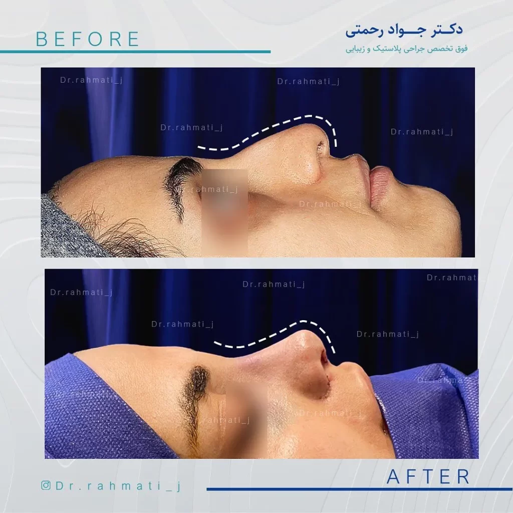 نمونه کار جراحی بینی