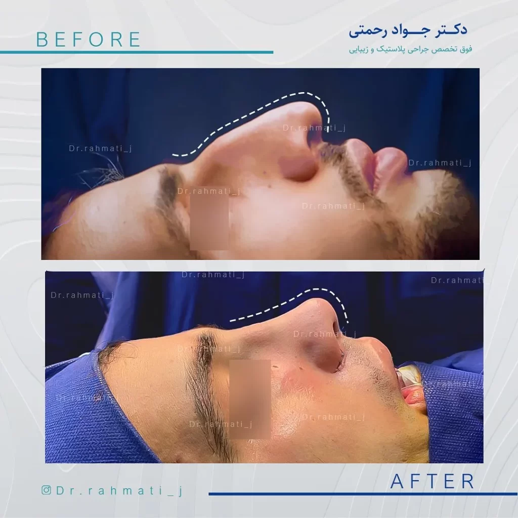 نمونه-کار-جراحی-بینی-استخوانی