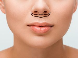 جراحی لیفت سانترال لب