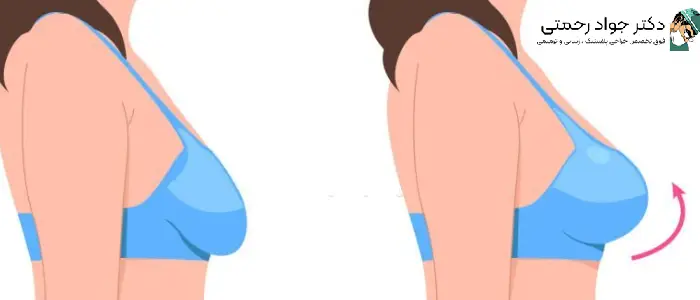 بهترین جراح لیفت سینه در تهران